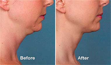 side profile of woman before and after kybella treatment, double chin gone afterwards