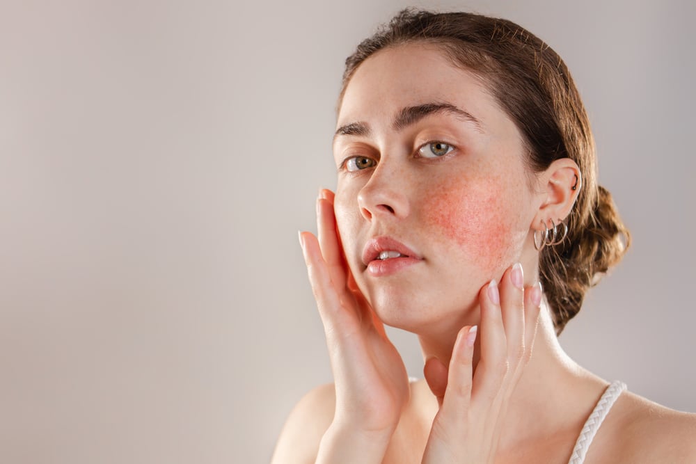 Medicine and cosmetology. Portrait of a young beautiful brunette woman with rosacea on her cheeks. Copy space.