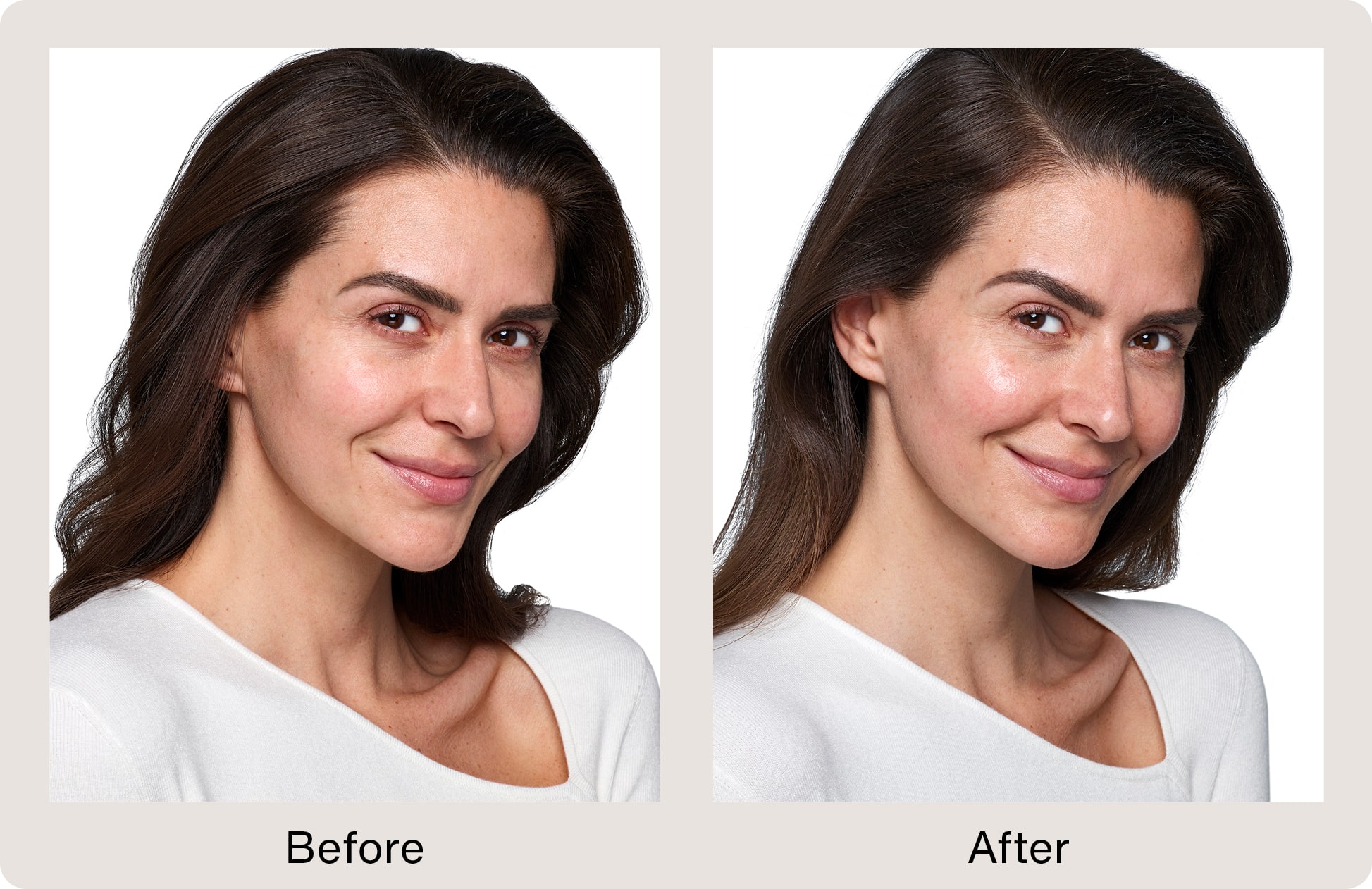 Janina treated by Skinvive - before and after photos